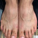 홀드핀칭 | 문제성발톱&lt;홀드핀칭 네일제작소 : 전주 무좀발톱, 전주내성발톱, 전주 네일아트, 전주패디큐어&gt;