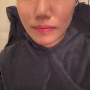 강남우태하피부과의원 | 강남피부과의원 티타늄리프팅 효과 후기(내돈내산💸)