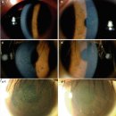 씨제이(C.J)홈마트 | epithelial-stromal dystrophy, 상피-기질각막이영양증