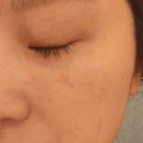 NO.1 자동차피부과 | 구월동피부과 기미레이저 피코토닝 줌패스 1회차 효과 후기