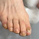 문제성 손, 발 오감네일 이미지