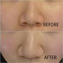 마음에점을찍다 | 인덕원피부관리 마음에 점을 찍다 안양점 | 닥터필 필링 후기