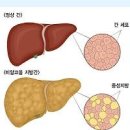 지방간 간수치 ALT AST 정상 범위 간수치 높을 때 나타나는 증상 5가지 이미지