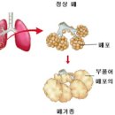 폐가 부풀어 오르는 질환 폐기종 증상 및 원인과 치료 이미지