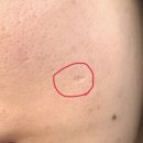 차한의원 | 새살침 3회차 후기｜후한의원 수원 트랜스테라피 내돈내산 여드름 흉터
