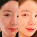 압구정역피부과 피코토닝 플라듀오로 기미제거 다운타임 후기