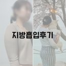 제일씨엔씨( C&C) | [지방 흡입 후기] 팔뚝지방 흡입 한지 6개월 (흉터, 관리, 부작용 등등 솔직한 썰 풀게요)