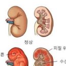 소변볼때 허리 통증 콕콕 쑤시는 까닭 &#39;이것&#39; 알기 이미지