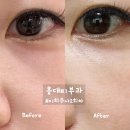 미희네 | 홍대피부과 눈밑꺼짐 다크서클 미희 콜라겐주사 2회차 후기