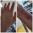라온약국 | 허혈성 결장염 및 장꼬임 (장폐색)으로 절제 수술하고온 후기 건강챙깁시다ㅜㅜ