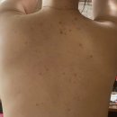 진도약초 | [내돈내산] 웨딩촬영 전 등드름 흉터 관리 후기 (통증, 가격, 비추천 이유?)