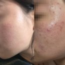 (광고X) 1년간의 성인 여드름 모낭염 탈출기 1탄 - 피부과, 여드름약, 베아로반, 수란트라 후기