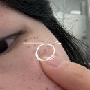 세안의원 | 루나의원 루비레이저 내돈내산 후기, 딱지+가격 등(기미레이저 508방)