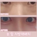 이즈음 | 눈밑지방재배치 경과 후기, 붓기 멍 다크서클 부작용 총정리