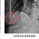 갈비뼈 골절 증상 회복기간 갈비뼈 금갔을때 통증 이미지