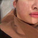 필로의원 | 잠실새내역 피부과 베러미의원 연어주사 2cc + 아쿠아필 + 스킨보톡스 후기