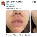 人中 reduction surgery 이미지