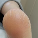 나도손톱 레푸스 개봉점 이미지