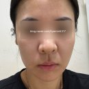 프라임약국 | 프라임레이즈 3회 + 올리디아 시술후기