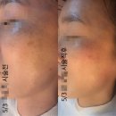 소닉메디케어 | 광주 첨단 꼼꼼하게 피부관리 잘하는 집 플라즈마 기미 잡티제거[메디케어 스킨앤바디]