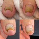 효자당약국 | 손, 발톱 (무좀, 파고드는 손, 발톱 치료)내돈내산 레푸스 효자점 방문 솔직후기 / 교정 가격 및 관리 방법