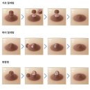 다양한 유두성형 기술 이미지