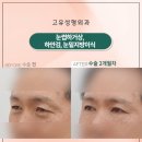 고유성형외과의원 | 눈썹하거상, 하안검, 눈밑지방이식 전후 2개월 후기｜고유성형외과 조건 원장 자연스러운 눈성형 사례
