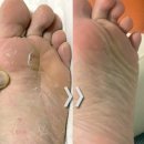 봄약국 | 무좀 스프레이 연고 약국 유명템 비교해봄 + 2달 케어후기