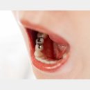 후회하지 않는 치과치료（1）「은치(銀歯)」는 폐해가 많아 해외는 금지하고 있다 이미지