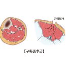 구획 증후군 (Compartment syndrome)근골격질환, 응급질환이란? 이미지