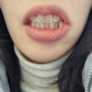 매복치 발치 후기, 강남 더페이스치과 내돈내산 / 교정 발치: 발치 시간 및 비용