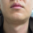 11650-16-6-1 | 성수피부과 레이저제모 16회차 후기 젠틀맥스프로플러스 효과