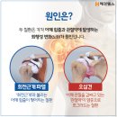 오십견의 원인과 비수술적 치료 이미지