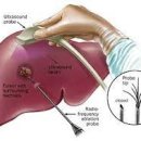 고주파 열치료[radiofrequency ablation, RFA] 이미지