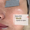 보누스킨 | 군자피부관리 보누스킨 후기 승모근 뿌시기