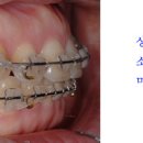 [압구정연치과][강남치과][압구정치과] 돌출입과 잇몸과다노출의 교정치료 이미지