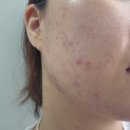 성인여드름으로 망가진 피부 극복 후기 (사랑해요 피부한의원)