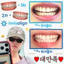 달성2차3로 | (사진많음) 강남 논현 인비절라인 내돈내산 2차 후기 | 투명교정 비발치 과개교합 나비치아 미세돌출