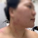 버드에너지위례제일 | [성남/위례] 위례에스테틱 더라인리셋, 일자목 버섯목...고주파로 승모 견갑 윤곽 관리 받고 온 찐 후기👍