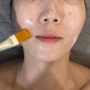 목은한의원 | 강남역한의원 아인침 편평사마귀 얼굴+목 제거 전후 비교 후기