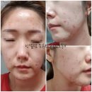 불꽃 인셀덤 | 인셀덤 효과 내 피부는 어떻게 달라졌을까? 인셀덤 사용후기