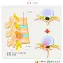 ‘죽을 병’은 아니지만, 방치하면 삶이 괴로워요 이미지