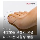 메디인 | 메디인랩 내성발톱 교정기 교정 파고드는 내향성 발톱 테이프 구매후기들 살펴보기