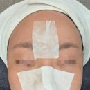 벨뷰의원 | 아쿠아필링 내돈내산 효과 후기:강남역 벨뷰 의원에서 직접 받아본 시술 리얼 리뷰