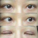 압구정 미소라인 성형외과ㅣ쌍꺼풀 재수술 두줄따기 흉살 2~5일차 사진+실밥 제거 후기
