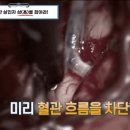 고난이도라는 뇌 혈전 제거 수술 장면 (혐주의).GIF 이미지