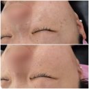 중동뷰티호텔 | [부천/상동]30년 만에 깨순이 탈출한 리얼 후기 + 전후 사진 있음 깨 털고 왔어요 기미 주근깨 흑자...