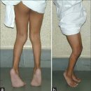 세움보조기 이미지