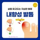 👣수술 후에도 재발하기 쉬운 내향성 발톱 이미지