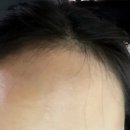 썬헤어라인 | 대구 두피관리 | 두피관리전문가가 진행하는 소이스칼프smp 헤어라인 시술 후기